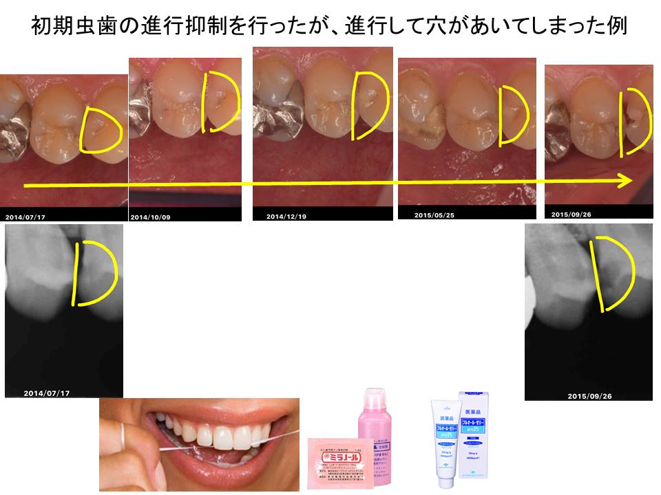 し　初期虫歯の進行抑制を行っていたが、14か月経過後、進行して穴があいてしまった例（2015-0926）